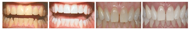 whitening